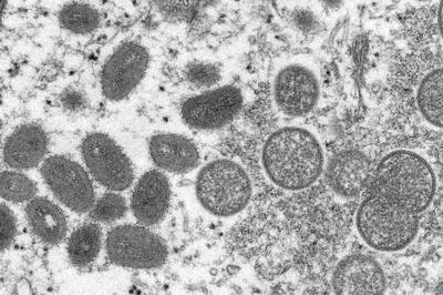 This 2003 electron microscope image made available by the Centers for Disease Control and Prevention shows mature, oval-shaped monkeypox virions, left, and spherical immature virions, right, obtained from a sample of human skin associated with the 2003 ...