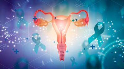 La endometriosis se relaciona con probabilidades cuatro veces más altas de cáncer de ovario