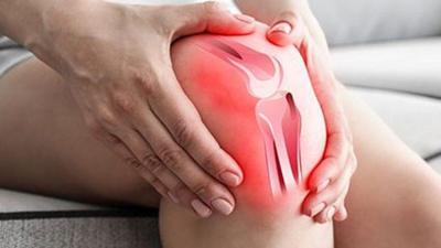 Un procedimiento arterial puede ofrecer una forma de aliviar la artritis de rodilla sin cirugía