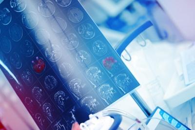 Un dispositivo de ultrasonido administra medicamentos para combatir mejor los tumores cerebrales