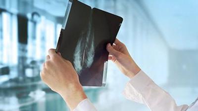 La IA podría ayudar a detectar la propagación del cáncer de mama sin necesidad de biopsia