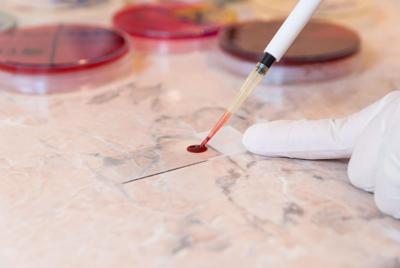 Un análisis rápido de sangre puede mejorar el tratamiento del accidente cerebrovascular