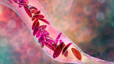 El ciclo menstrual podría estar contribuyendo a los eventos de dolor causado por anemia de células falciformes