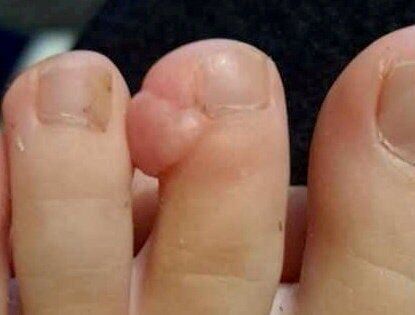 Girl diagnosed with rare tumour after it was mistaken for a wart