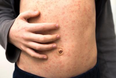 La caída de las tasas de vacunación provoca picos de sarampión en todo el mundo