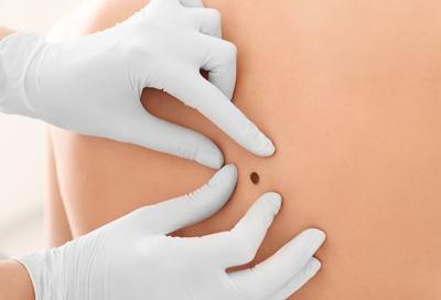 Un análisis de sangre puede predecir la recurrencia del melanoma