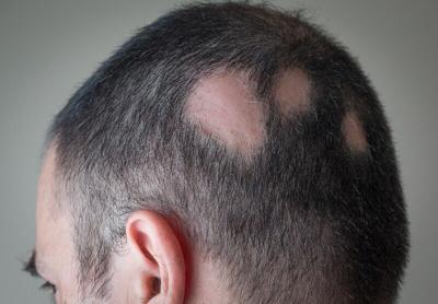 alopecia