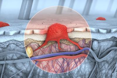 El herpes genital afecta a 1 de cada 5 adultos jóvenes en todo el mundo