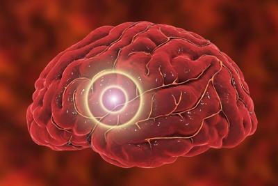 La stimulación cerebral transcraneal en el hogar puede aliviar la depresión de manera segura