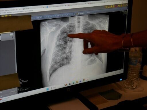 Lisa Emery, director of the Breathing Center and Black Lung Clinic at New River Health, shows an X-ray of the lungs of a miner suffering from black lung disease
