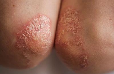 La grasa abdominal está relacionada con la psoriasis