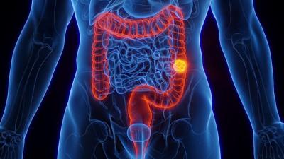 Esta puntuación puede predecir el riesgo de cáncer de colon temprano