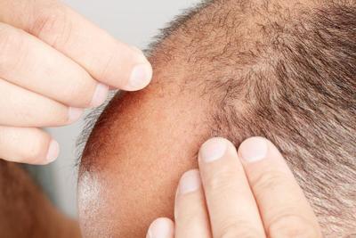 La FDA advierte sobre productos no aprobados para la caída del cabello relacionados con efectos secundarios