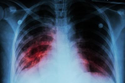 Una vez más, la tuberculosis se convierte en la principal causa de muerte por enfermedades infecciosas en el mundo