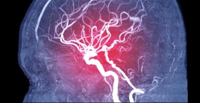 El tratamiento con estimulación cerebral profunda podría hacer que los brazos y las manos recuperen la movilidad